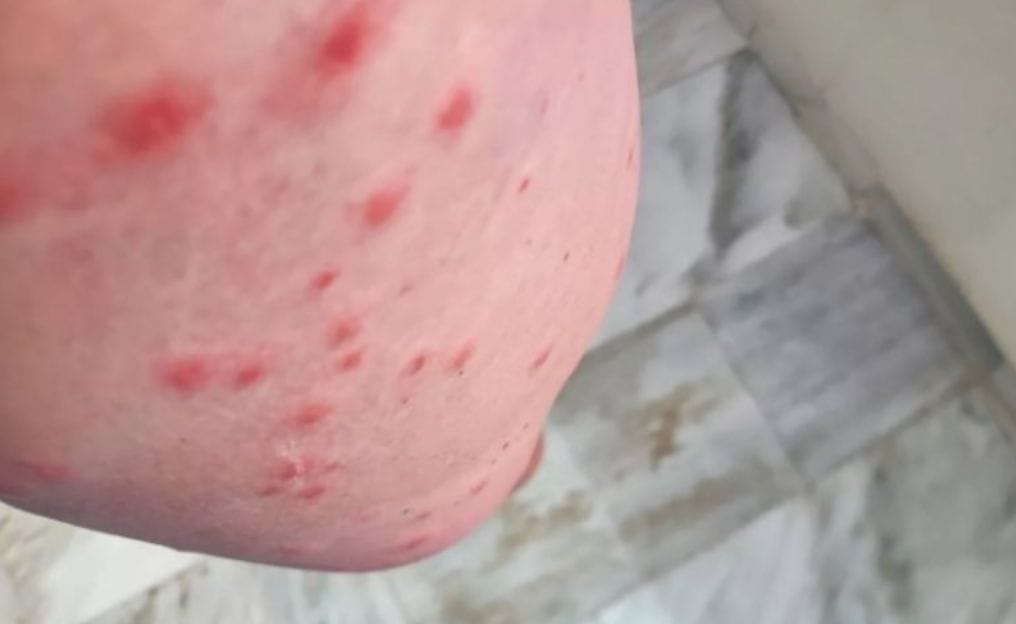 A Vacation Nightmare: Mother Fights for Life After Mosquito Bite Complications in&nbsp;Tenerife